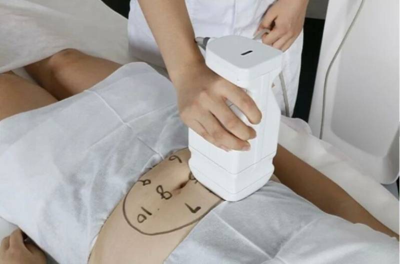 LE LIPOSONIX HIFU pour raffermir le ventre à Strasbourg